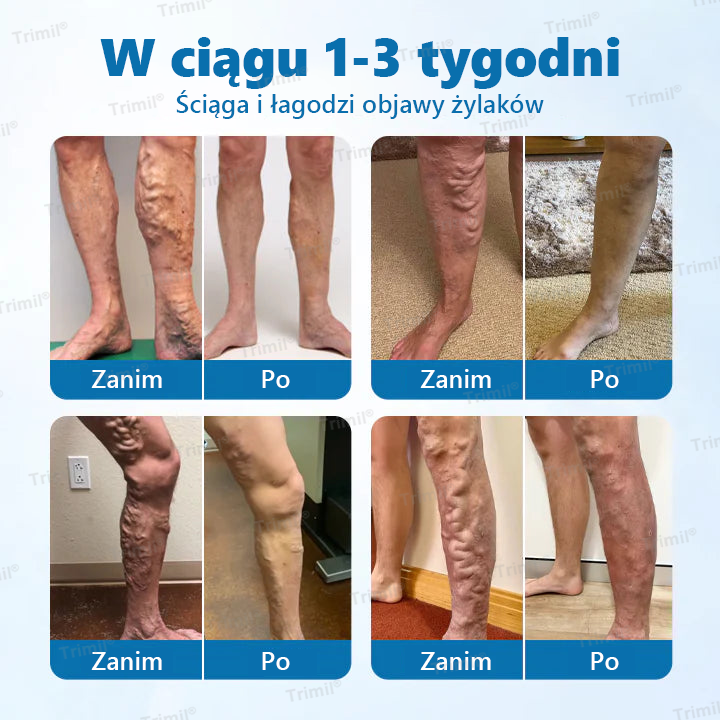 Trimil® Ziołowy Spray na Ochronę Żył – ✅Klinicznie udowodniono, że eliminuje żylaki w zaledwie 7 dni!💚
