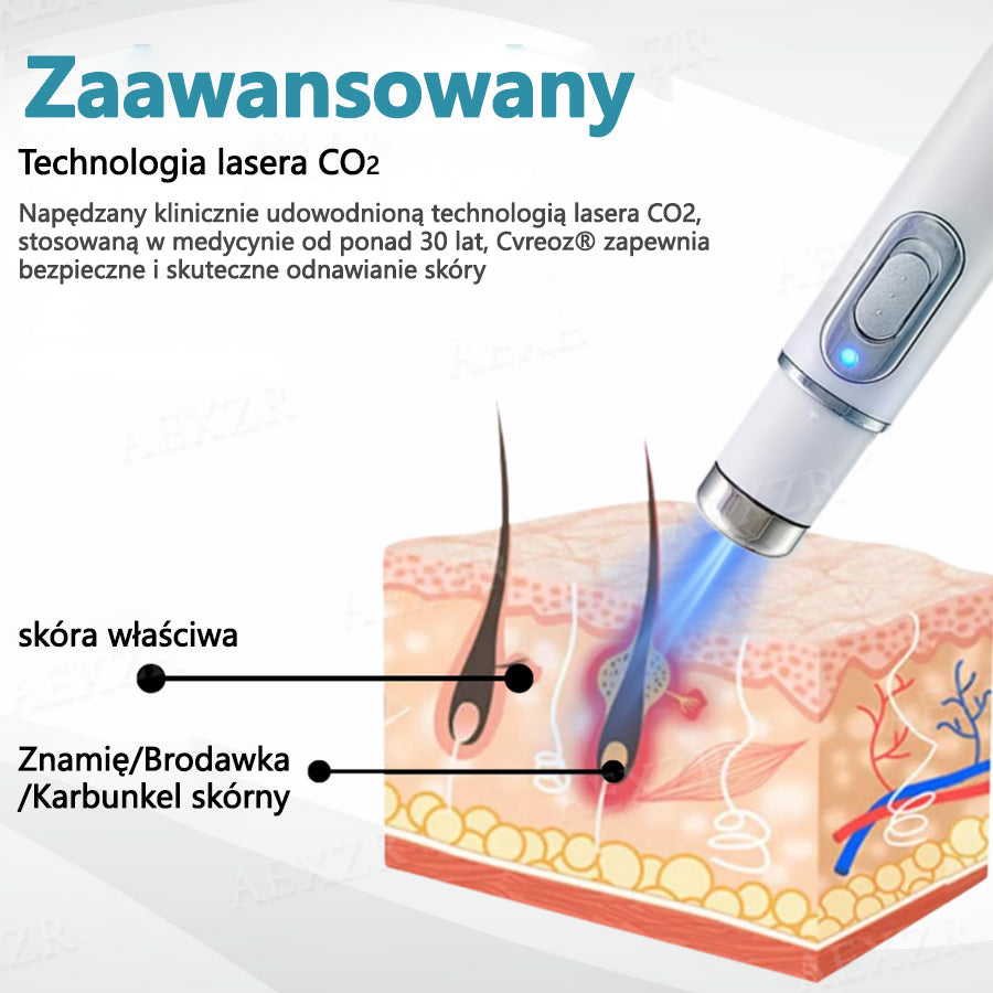 Cvreoz® nowy nieinwazyjny laser do usuwania pieprzyków i brodawek 🎉🎉🎉