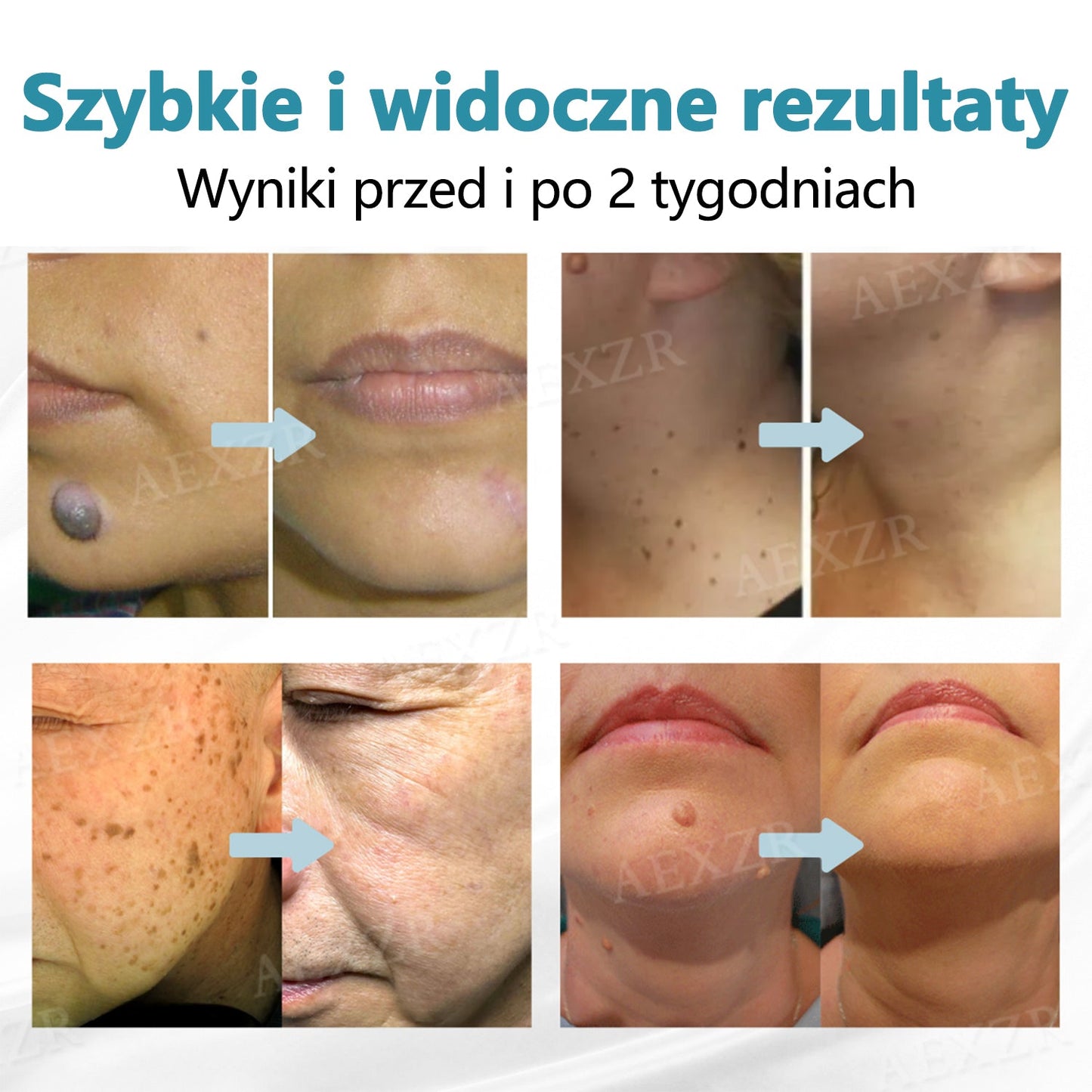 Cvreoz® nowy nieinwazyjny laser do usuwania pieprzyków i brodawek 🎉🎉🎉