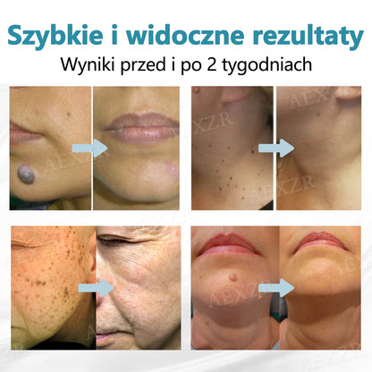Cvreoz® nowy nieinwazyjny laser do usuwania pieprzyków i brodawek 🎉🎉🎉