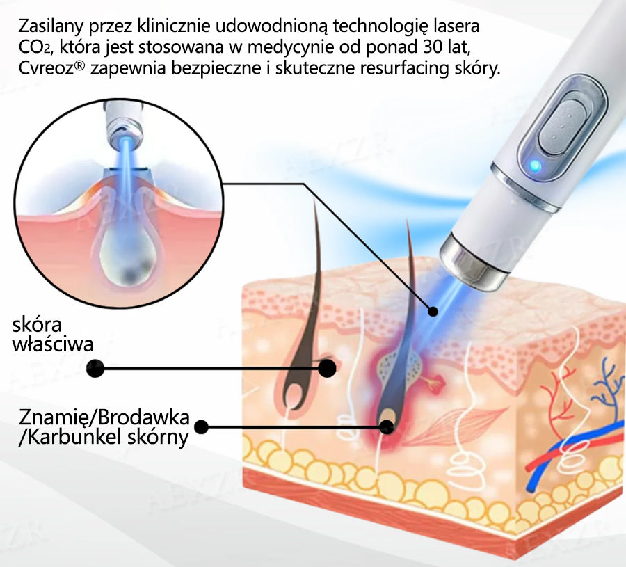 Cvreoz® nowy nieinwazyjny laser do usuwania pieprzyków i brodawek 🎉🎉🎉