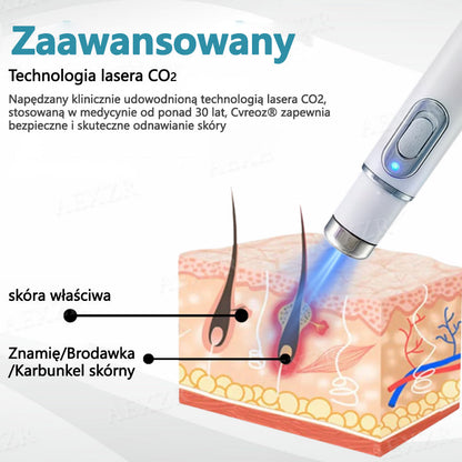 Cvreoz® nowy nieinwazyjny laser do usuwania pieprzyków i brodawek 🎉🎉🎉