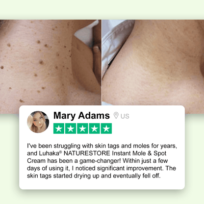 ✅Sklep oficjalny: Krem Luhaka® NATURESTORE na pieprzyki i plamy